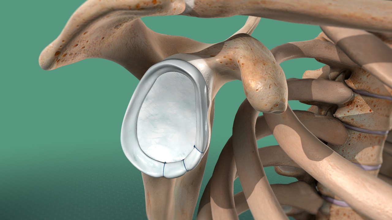 Knee Replacement in Bangalore