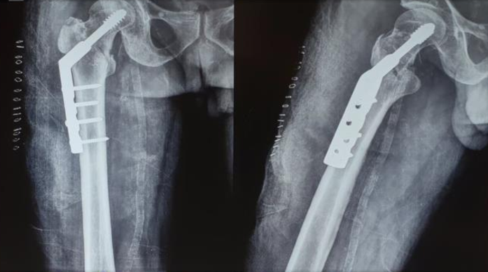 Intertrochanteric Fracture Treatment in Malleswaram