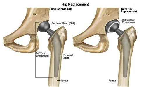 Total Hip Replacement