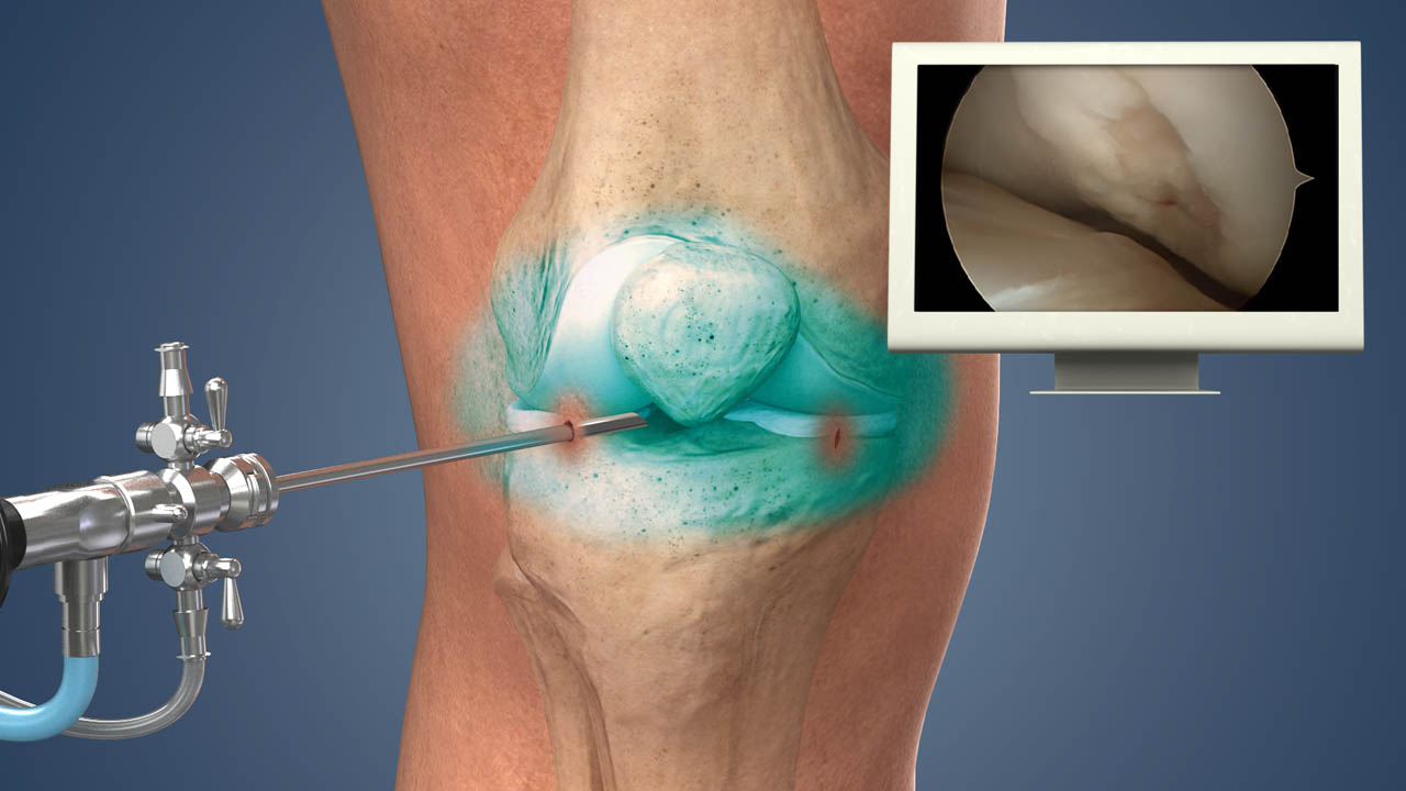 Arthroscopy Surgery in Malleswaram