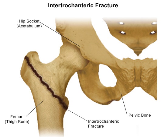 Hip Fracture Treatment in Malleswaram