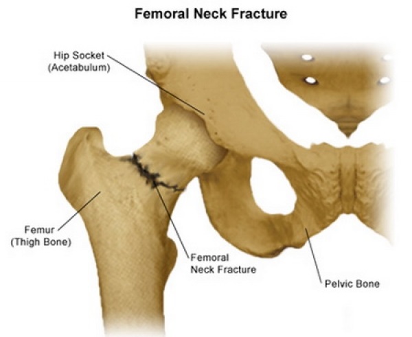 Neck of Femur Fracture Treatment in Malleswaram