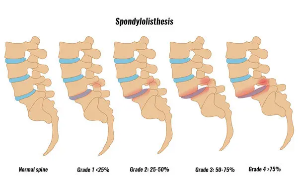 Spondylolisthesis Treatment in Malleswaram