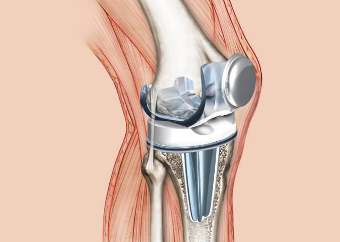 Revision Joint Replacement