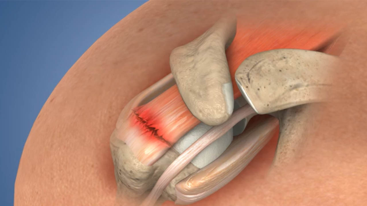 Rotator Cuff Repair in Malleswaram